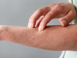 Kanker Sarkoma: Ancaman Tersembunyi yang Serang Kalangan Kaum Milenial