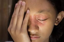 Waspadai Lupus Sejak Dini, Pentingnya Pemeriksaan Berkala untuk Anak Perempuan