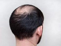 Dokter Spesialis ungkap Cara Mengatasi Risiko Kebotakan Rambut pada Pria dan Wanita