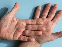 Penularan Virus Cacar Monyet Varian Clade Ib Terindikasi Lebih Cepat dan Parah
