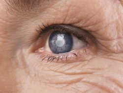 Katarak, Penyebab Utama Kebutaan: Pentingnya Skrining Sejak Dini